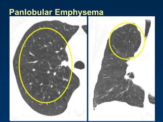 Panlobular Emphysema
 