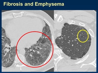 Fibrosis and Emphysema
 