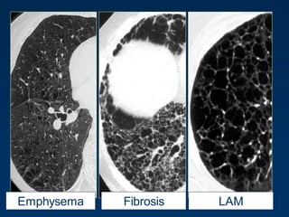 LAMEmphysema Fibrosis
 