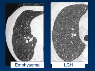 LCHEmphysema
 