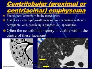 Centrilobular (proximal or
centriacinar) emphysema
Found most commonly in the upper lobes
Manifests as multiple small areas of low attenuation without a
perceptible wall, producing a punched-out appearance.
Often the centrilobular artery is visible within the
centre of these lucencies.
121
 