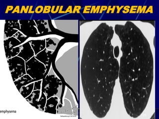 PANLOBULAR EMPHYSEMA
125
 