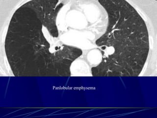 Panlobular emphysema
 