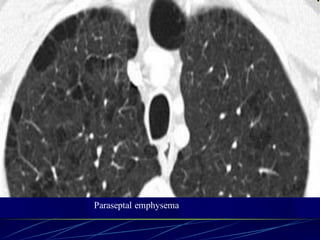 Paraseptal emphysema
 