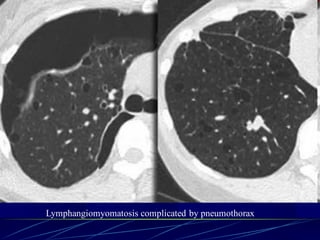 Lymphangiomyomatosis complicated by pneumothorax
 