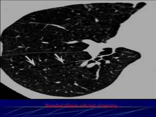 Bronchial dilation with lack of tapering .
 