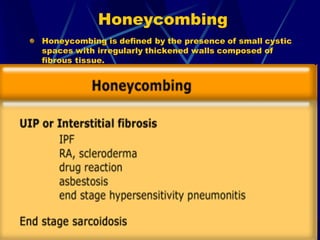 Honeycombing
Honeycombing is defined by the presence of small cystic
spaces with irregularly thickened walls composed of
fibrous tissue.
 