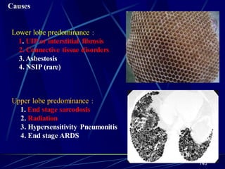Causes
Lower lobe predominance :
1. UIP or interstitial fibrosis
2. Connective tissue disorders
3. Asbestosis
4. NSIP (rare)
Upper lobe predominance :
1. End stage sarcodosis
2. Radiation
3. Hypersensitivity Pneumonitis
4. End stage ARDS
140
 