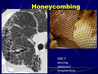 Honeycombing
HRCT
showing
subpleural
broncheolecta
 
