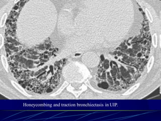 Honeycombing and traction bronchiectasis in UIP.
 