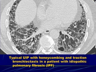 Typical UIP with honeycombing and traction
bronchiectasis in a patient with idiopathic
pulmonary fibrosis (IPF)
 