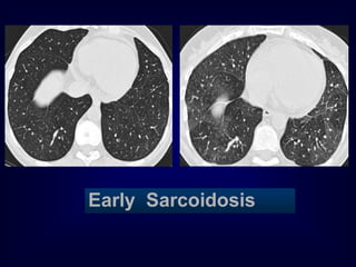 Early Sarcoidosis
 