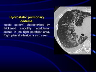 Hydrostatic pulmonary
oedema
“septal pattern” characterised by
thickened smoothly interlobular
septae in the right parahilar area.
Right pleural effusion is also seen
 