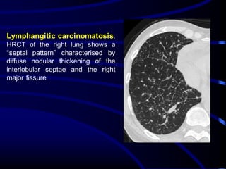 Lymphangitic carcinomatosis.
HRCT of the right lung shows a
“septal pattern” characterised by
diffuse nodular thickening of the
interlobular septae and the right
major fissure
 