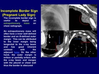 Incomplete Border Sign
(Pregnant Lady Sign)
The incomplete border sign is
useful to depict an
extrapulmonary mass on
chest radiograph.
An extrapulmonary mass will
often have a inner well defined
border and an ill-defined outer
margin . This can be attributed
to the inner margin being
tangential to the x-ray beam
and has good inherent
contrast with the
adjacent lung. On the other
hand, the outer margin is
enface or partially enface with
the x-ray beam and merges
with the pleural or chest wall
thus the border is obscured
 