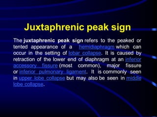 Juxtaphrenic peak sign
The juxtaphrenic peak sign refers to the peaked or
tented appearance of a hemidiaphragm which can
occur in the setting of lobar collapse. It is caused by
retraction of the lower end of diaphragm at an inferior
accessory fissure (most common), major fissure
or inferior pulmonary ligament. It is commonly seen
in upper lobe collapse but may also be seen in middle
lobe collapse.
 
