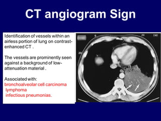 CT angiogram Sign
Identification of vessels within an
airless portion of lung on contrast-
enhanced CT .
The vessels are prominently seen
against a background of low-
attenuation material .
Associatedwith:
bronchoalveolar cell carcinoma
lymphoma
infectious pneumonias.
 
