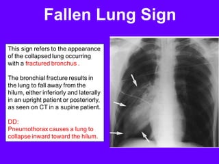 Fallen Lung Sign
This sign refers to the appearance
of the collapsed lung occurring
with a fractured bronchus .
The bronchial fracture results in
the lung to fall away from the
hilum, either inferiorly and laterally
in an upright patient or posteriorly,
as seen on CT in a supine patient.
DD:
Pneumothorax causes a lung to
collapse inward toward the hilum.
 