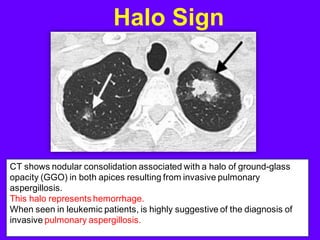 Halo Sign
CT shows nodular consolidation associated with a halo of ground-glass
opacity (GGO) in both apices resulting from invasive pulmonary
aspergillosis.
This halo represents hemorrhage.
When seen in leukemic patients, is highly suggestive of the diagnosis of
invasive pulmonary aspergillosis.
 