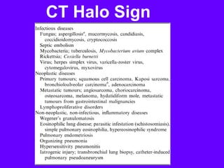 CT Halo Sign
 