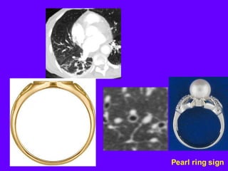 Pearl ring sign
 