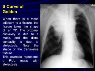 S Curve of
Golden
When there is a mass
adjacent to a fissure, the
fissure takes the shape
of an "S". The proximal
convexity is due to a
mass, and the distal
concavity is due to
atelectasis. Note the
shape of the transverse
fissure.
This example represents
a RUL mass with
atelectasis
 