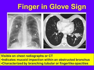 Finger in Glove Sign
Visible on chest radiographs or CT
•Indicates mucoid impaction within an obstructed bronchus
•Characterized by branching tubular or fingerlike opacities
 