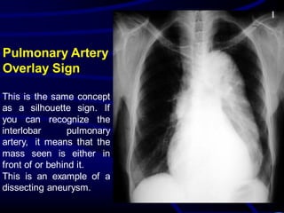 Pulmonary Artery
Overlay Sign
This is the same concept
as a silhouette sign. If
you can recognize the
interlobar pulmonary
artery, it means that the
mass seen is either in
front of or behind it.
This is an example of a
dissecting aneurysm.
 