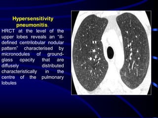 Hypersensitivity
pneumonitis.
HRCT at the level of the
upper lobes reveals an “ill-
defined centrilobular nodular
pattern” characterised by
micronodules of ground-
glass opacity that are
diffusely distributed
characteristically in the
centre of the pulmonary
lobules
 