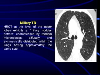 Miliary TB
HRCT at the level of the upper
lobes exhibits a “miliary nodular
pattern” characterised by random
micronodules diffusely and
symmetrically distributed within the
lungs having approximately the
same size
 