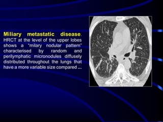 Miliary metastatic disease.
HRCT at the level of the upper lobes
shows a “milary nodular pattern”
characterised by random and
perilymphatic micronodules diffusely
distributed throughout the lungs that
have a more variable size compared ...
 