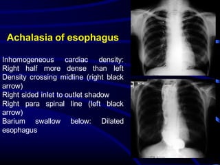 Achalasia of esophagus
Inhomogeneous cardiac density:
Right half more dense than left
Density crossing midline (right black
arrow)
Right sided inlet to outlet shadow
Right para spinal line (left black
arrow)
Barium swallow below: Dilated
esophagus
 