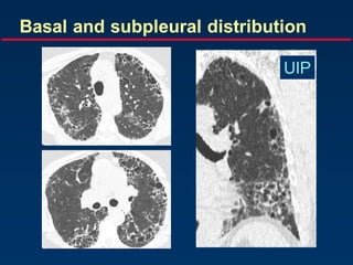Basal and subpleural distribution
UIP
 