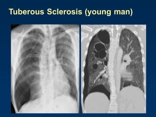 Tuberous Sclerosis (young man)
 
