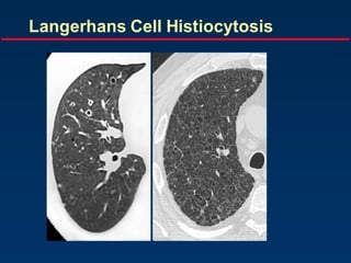 Langerhans Cell Histiocytosis
 