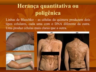 Herança quantitativa ou
poligênica
Linhas de Blaschko – as células da quimera produzem dois
tipos celulares, cada uma com o DNA diferente da outra.
Uma produz células mais claras que a outra.
 