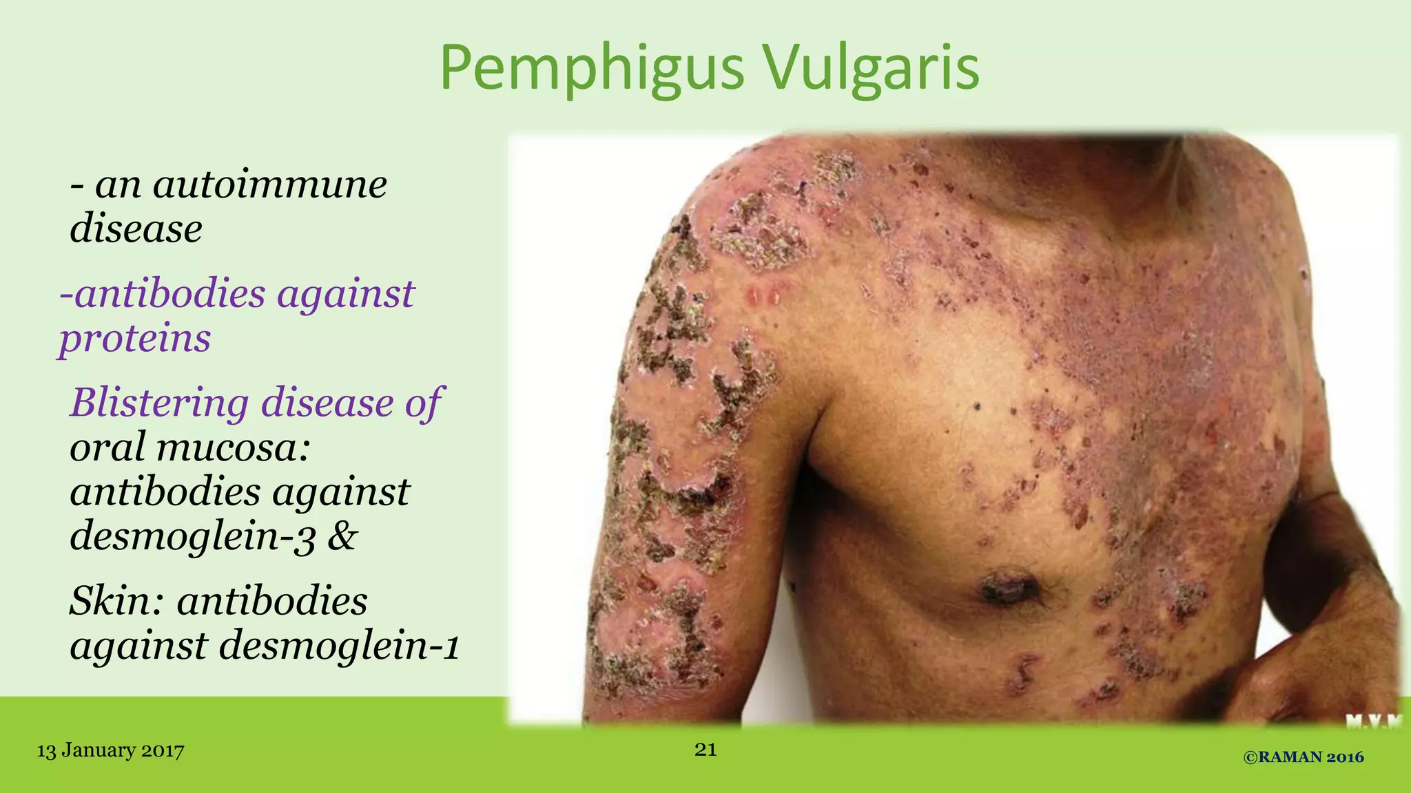 Pemphigus Vulgaris
- an autoimmune
disease
-antibodies against
proteins
Blistering disease of
oral mucosa:
antibodies against
desmoglein-3 &
Skin: antibodies
against desmoglein-1
13 January 2017 ©RAMAN 201621
 