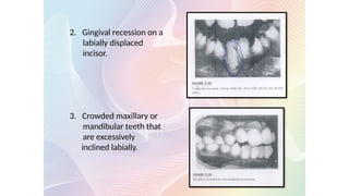 2. Gingival recession on a
labially displaced
incisor.
3. Crowded maxillary or
mandibular teeth that
are excessively
inclined labially.
 