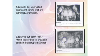 4. Labially but unerupted
permanent canine that are
extremely prominent.
5. Splayed out perm Max /
Mandi Incisor due to crowded
position of unerupted canines
 