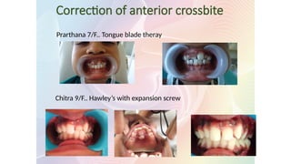 Correction of anterior crossbite
Prarthana 7/F.. Tongue blade theray
Chitra 9/F.. Hawley’s with expansion screw
 