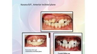 Kavana 8/F.. Anterior inclined plane
 