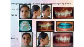 Management of Class I malocclusion with crowding using Trainer
Usha 12F
Pre op
Post op
 