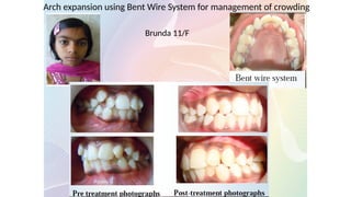 Arch expansion using Bent Wire System for management of crowding
Brunda 11/F
 