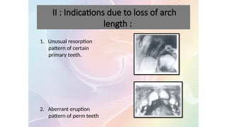 1. Unusual resorption
pattern of certain
primary teeth.
2. Aberrant eruption
pattern of perm teeth
II : Indications due to loss of arch
length :
 