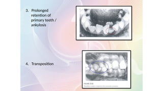 3. Prolonged
retention of
primary teeth /
ankylosis
4. Transposition
 