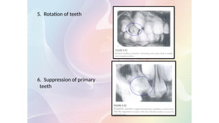 5. Rotation of teeth
6. Suppression of primary
teeth
 