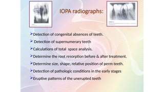 IOPA radiographs:
Detection of congenital absences of teeth.
 Detection of supernumerary teeth
Calculations of total space analysis.
Determine the root resorption before & after treatment.
Determine size, shape, relative position of perm teeth.
Detection of pathologic conditions in the early stages
Eruptive patterns of the unerupted teeth
 
