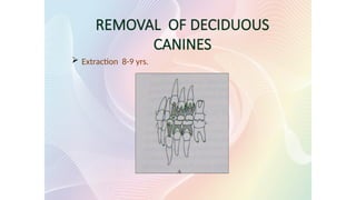 REMOVAL OF DECIDUOUS
CANINES
 Extraction 8-9 yrs.
 