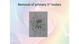 Removal of primary 1st
molars
 