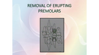 REMOVAL OF ERUPTING
PREMOLARS
 